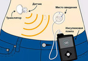 Искусственная поджелудочная железа: новое слово в лечении сахарного диабета
